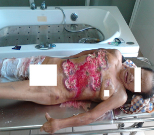 Lưu ý khi sử dụng các thuốc Y học dân tộc trong điều trị bỏng